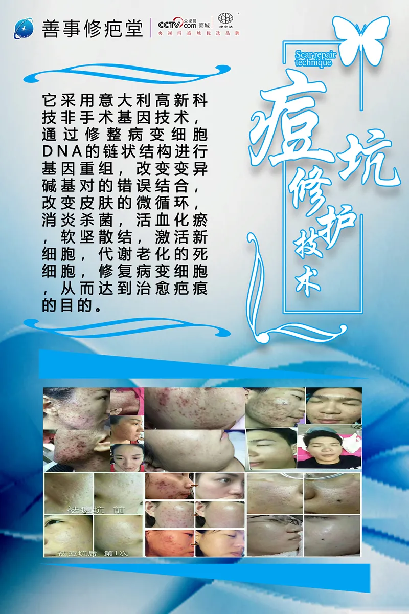 痘坑修护技术