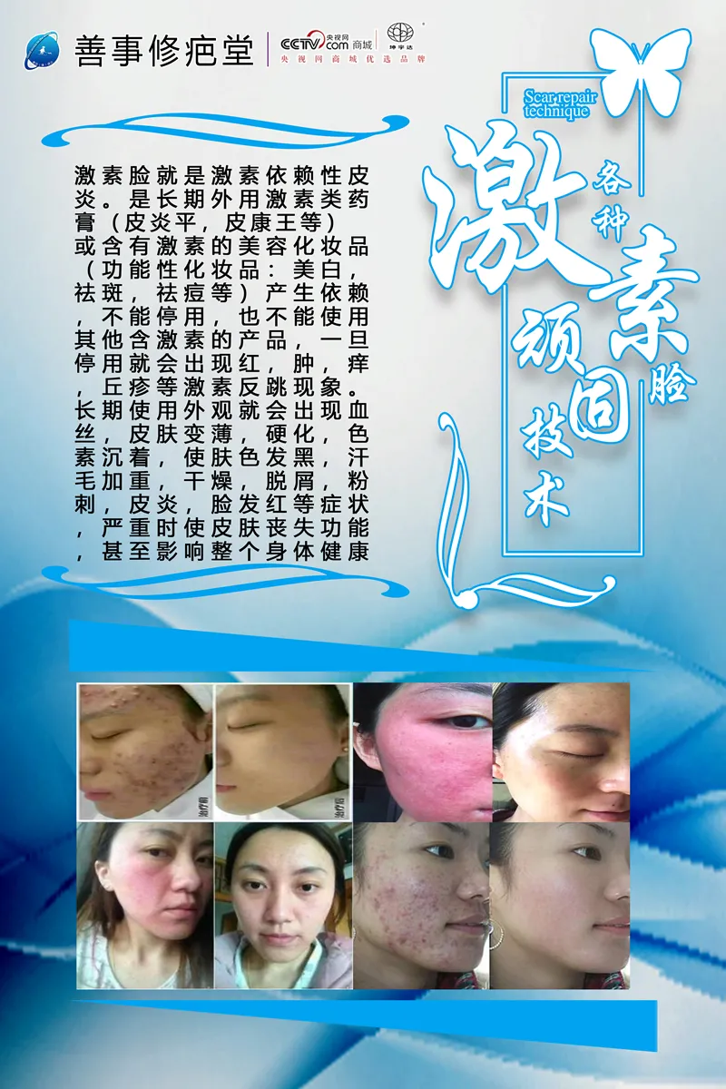 激素顽固技术
